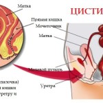 Чем лечить цистит при лактации: какие антибиотики и народные средства можно кормящей маме