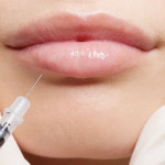 Можно ли увеличивать губы при грудном вскармливании